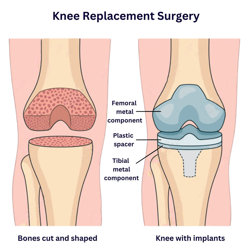 Why do you need a knee replacement?