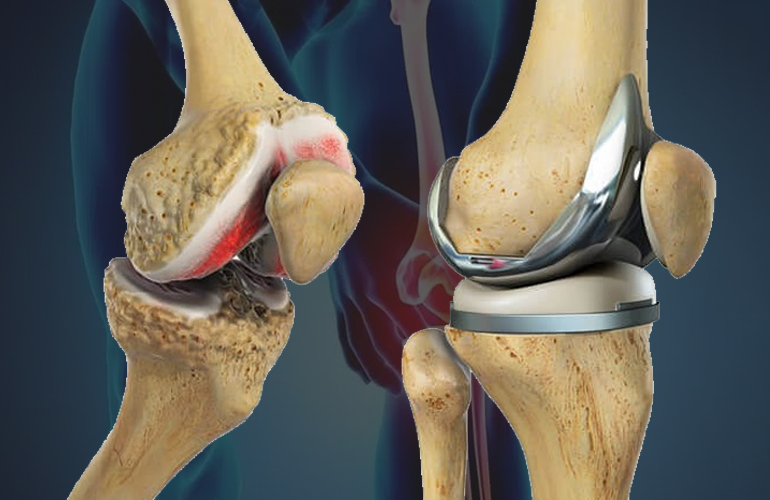 Knee Replacement Surgery