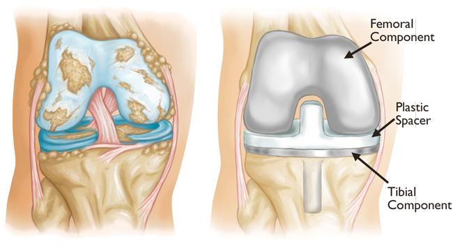 Knee Replacement Surgery in Mumbai by Kunal Makhija