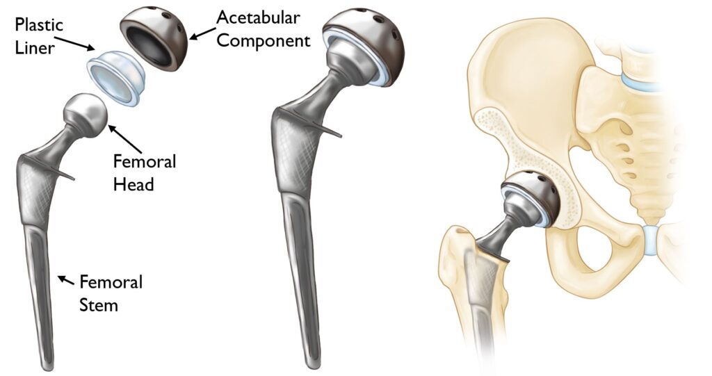 Benefits of hip replacement surgery