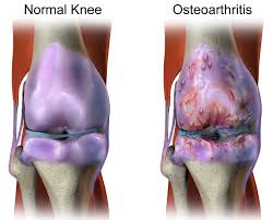 Osteoarthritis diagnosis