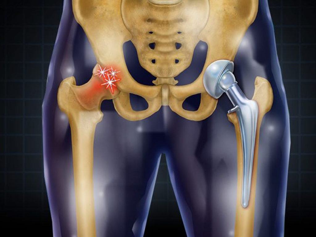 Hip replacement surgery