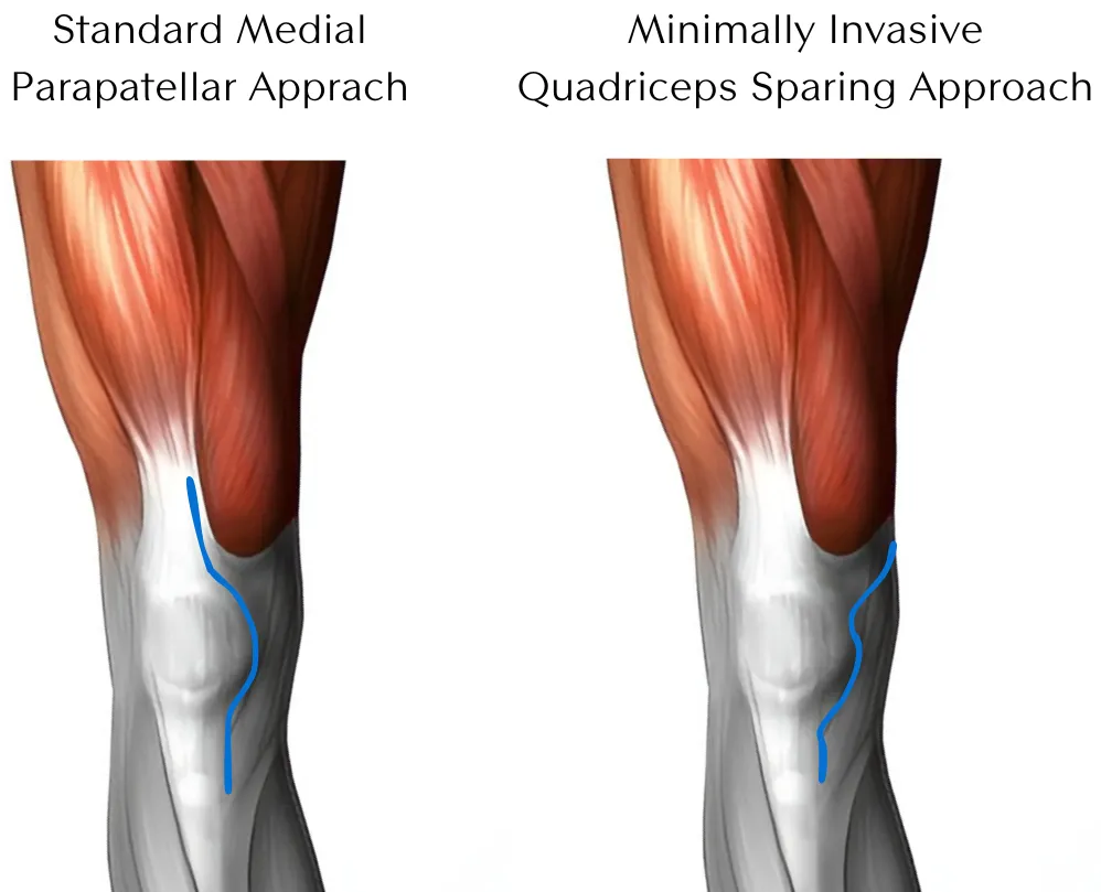  Advantages of Subvastus Knee Replacement Surgery