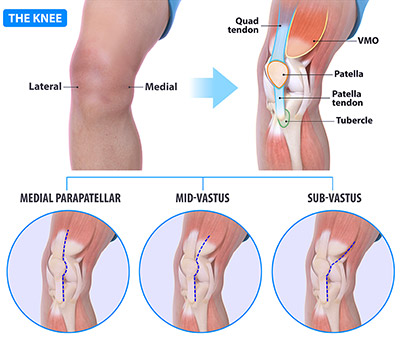 What is Subvastus Knee Replacement Surgery?