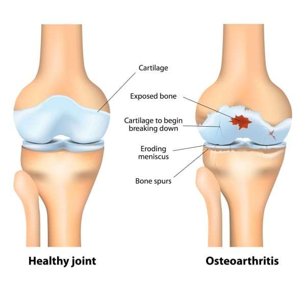 Osteoarthritis