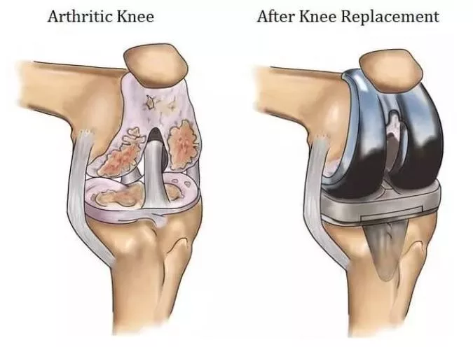 Knee replacement before after
