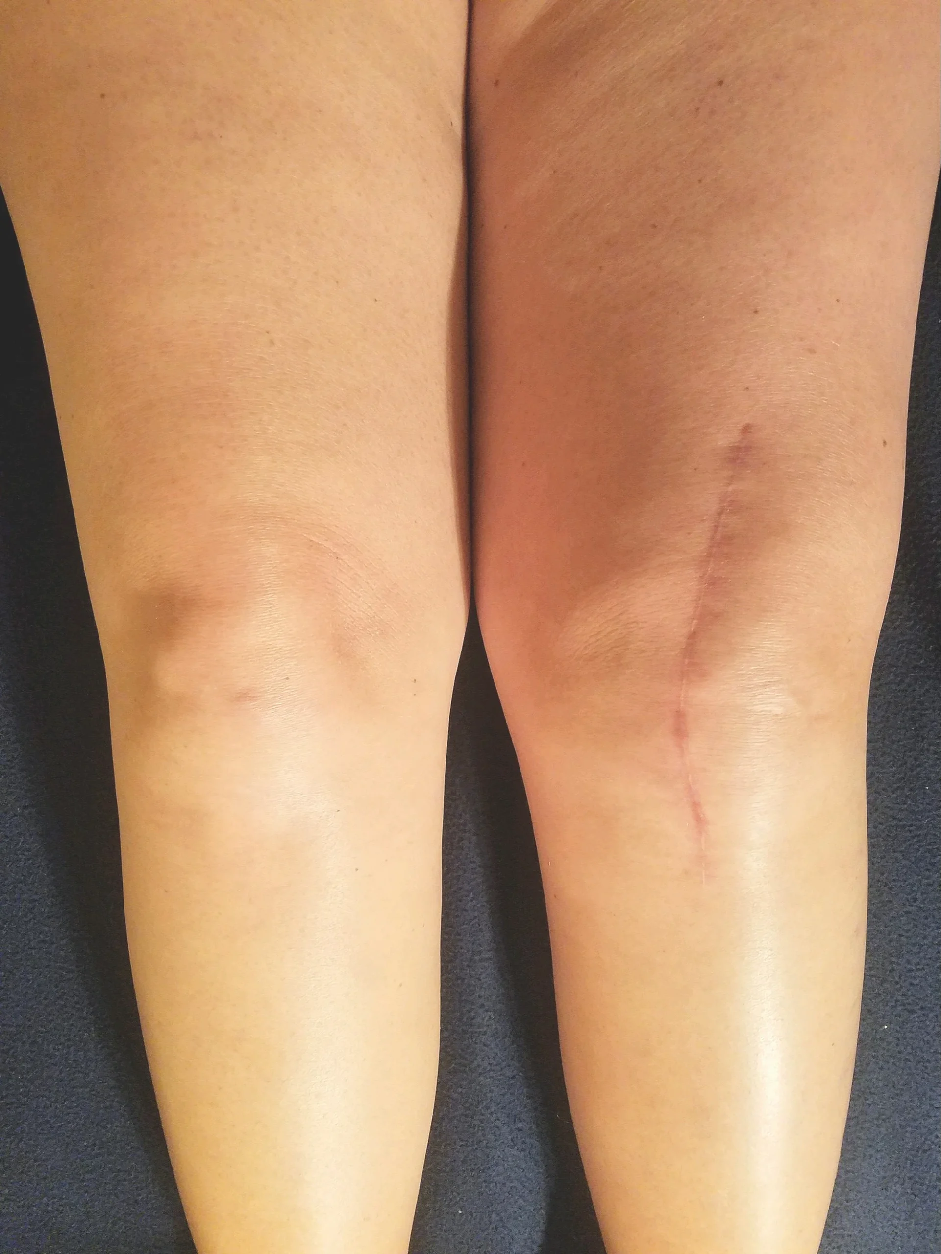 knee replacement in panvel