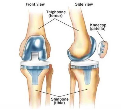 knee replacement in panvel by Dr. Kunal Makhija