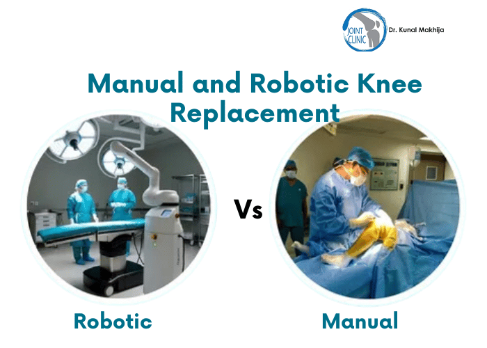 Choosing between manual and robotic knee replacement