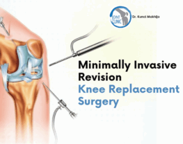 Minimally Invasive Revision Knee Replacement Surgery