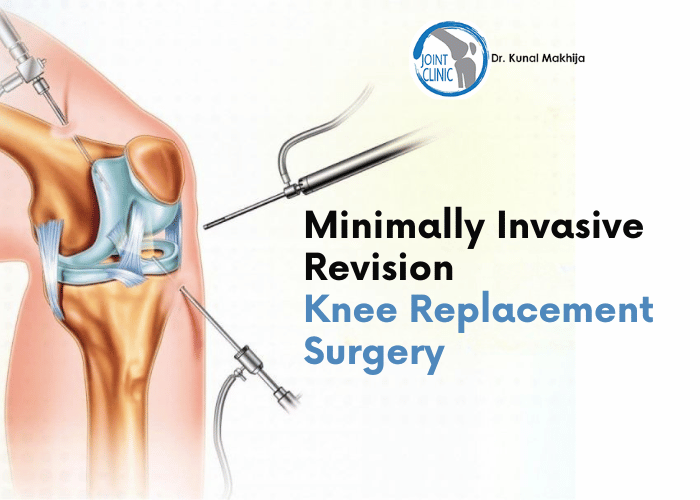 Minimally Invasive Revision Knee Replacement Surgery